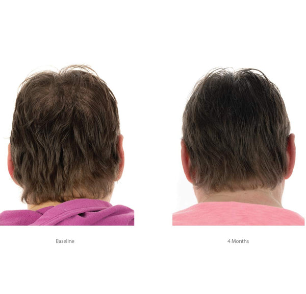 FOLIGAIN Balsamo a Tripla Azione per Capelli Diradati da Donna con il 2% di Trioxidil 473ml