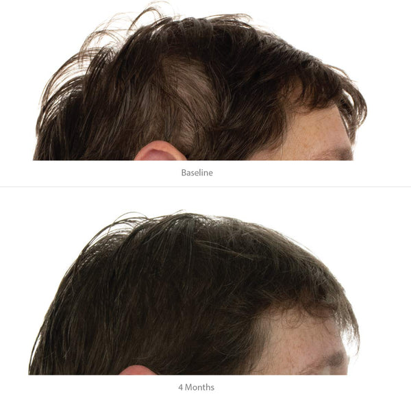 FOLIGAIN Balsamo a Tripla Azione per Capelli Diradati da Donna con il 2% di Trioxidil
